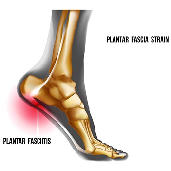 Plantar Fascitis Treatment San Antonio