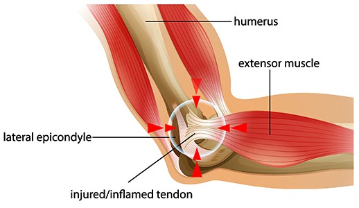 Tennis Elbow Treatment San Antonio