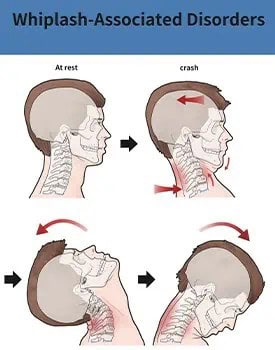 Whiplash Symptoms San Antonio